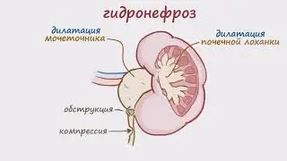 Гидронефроз