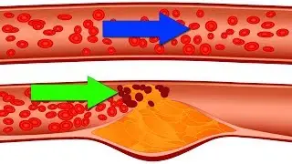 THESE 5 Products Clog Blood Vessels and Cause Heart Attacks (Don't Risk It)