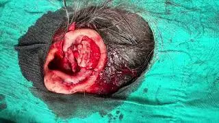 Piercing ear keloid