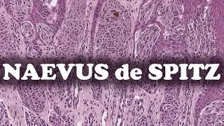 LE NEVUS DE SPITZ – PATHOLOGIE