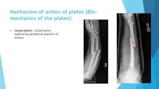 Orthopedic Trauma ; general principles: 1