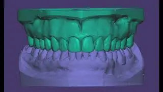 Wax up in Exocad !!! DEMO from Exocad North Team