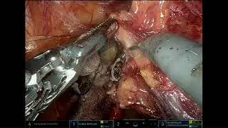 #220 Robotic Assisted TYPE II RADICAL HYSTERECTOMY FOR EARLY CERVICAL CA...- Dr. Rohit Ranade
