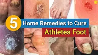 5 Home Remedies to Cure Your Athlete's Foot Permanently! | Credihealth 