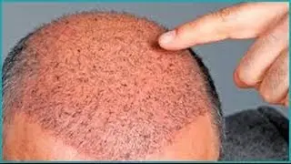 مشفى دار الشفاء لزراعة الشعر التفاصيل الخاصة لاصحاب الجلستين للحجز 00905555558555