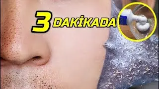 İlk Yaptığınızda Şaşıracaksınız ! DİŞ MACUNU İLE 3 DAKİKADA Siyah Nokta Yok Etme │ Güzellik Bakım