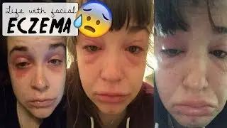 ECZEMA on the FACE - and my Current Weight