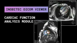 Сardiac function analysis additional module in Inobitec DICOM Viewer Pro