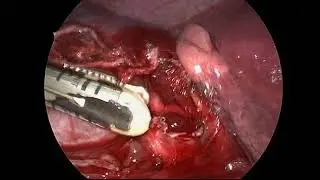 Fissure-Last VATS Left Lower Lobe Lobectomy
