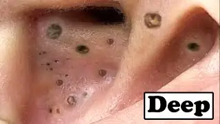 Best Removal Of Deep Big Blackheads In The Ear