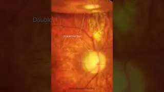Residual C3F8 bubble 6 weeks after retinal detachment surgery | #shorts
