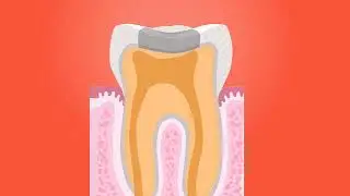 Tooth Root Canal Animated Surgical video for medical interns