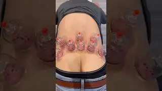 Wet Cupping For Low Back Pain Relief!