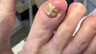 What happens to a bruised or injured toenail?  Subungual hematoma.  Why should it be treated?