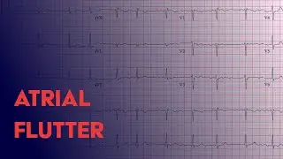 Atrial Flutter -  EKG (ECG) Interpretation