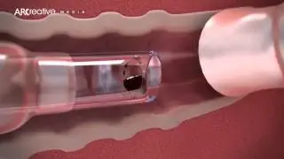 Arcreative Media - Early Works Showreel (Medical Device 3D Animation)