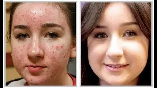 How to remove acne from your image effectively in Adobe Photoshop