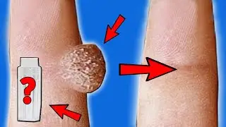 The Cheapest and Easiest Way to Get Rid of Warts and Papillomas