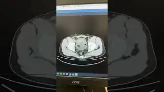 Хирург ставит диагноз острого аппендицита по КТ
