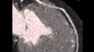 Coronary Artery Anatomy 7