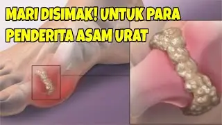 Mari DISIMAK! Info Penting Untuk Penderita Penyakit Asam Urat