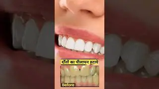 Danton ka peelapan jar se hatayen ! दातों का पीलापन जड़ से हटाए।