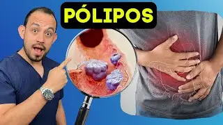 10 DATOS IMPORTANTES sobre Pólipos en el Colon: Síntomas, Causas, Estudios, Tratamiento y Prevención