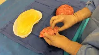 En Bloc removal of ruptured breast implant