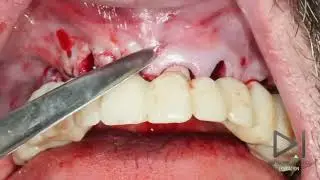 Digital Implantology Implant Surgery: Teeth in a hour with  open source software
