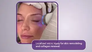 ENDYEye Non surgical eyelift