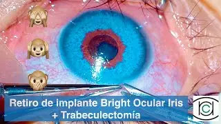 Retiro de implante cosmético de iris mas trabeculectomía