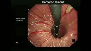 CAMERON LESIONS AND UPPER GASTROINTESTINAL BLEED