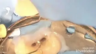 Root Canal Treatment Tips and Tricks- Part 2
