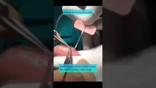 Testicular Sperm Extraction using the Fine needle biopsy technique