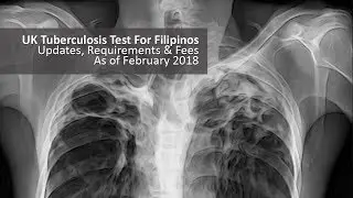 UK Settlement Visa Tuberculosis Test Clearance ~ February 2018 Update