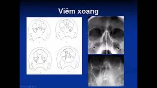 Chẩn đoán hình ảnh X-quang sọ - hàm mặt và một số bệnh lý hay gặp - PGS. TS. Vũ Đăng Lưu