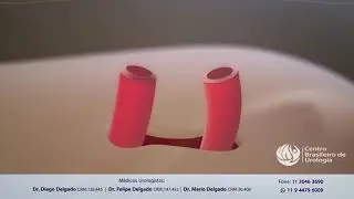 Reversão de Vasectomia - Dr. Diego Delgado