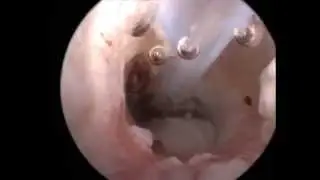 Мирингоцентез. Miringocentesis
