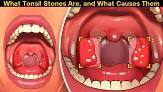 What Tonsil Stones Are, and What Causes Them | Health Video