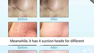 Blackhead Remover Vacuum - June Julien Facial Pore Cleanser Electric Acne Comedone Extractor Kit