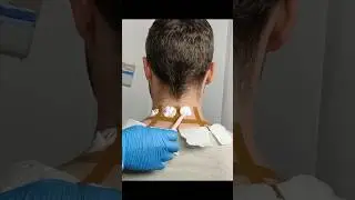 Allergy test on his neck