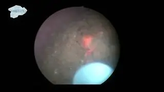 Laser Fragmentation of Large Bladder Stone