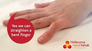 Yes, We Can Straighten Your Bent Finger!