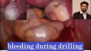 how to manage bleeding during ovarian drilling....?
