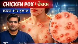 Chicken Pox Disease - Cause Symptoms and Treatment | Vaccine | चेचक का इलाज