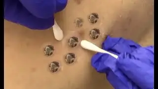 Extreme Blackhead Extraction From Back