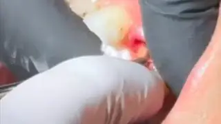 Extraction for upper remaining root