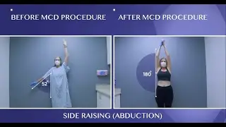 See How Our Patient was Cured From Frozen Shoulder!