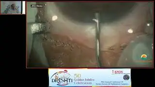 KSOS2023   Dr Chandrakanth K S   FP26   Study visual outcome and complication in 100Eyes by Phako Em