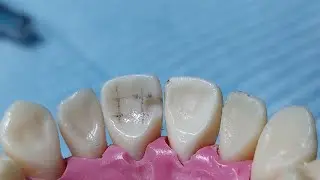 cavity preparation class III for Composite restoration/